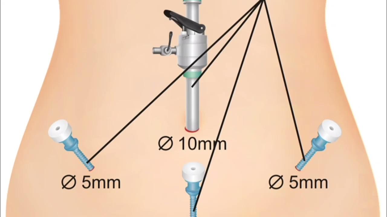 Сколько заживает после удаления матки. Лапароскопия гинекологические операции. Лапароскопия в гинекологии проколы. Лапароскопическая аппендэктомия лапароскопия. Лапароскопия точки введения троакаров.