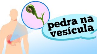 Quais os sintomas da PEDRA NA VESÍCULA?