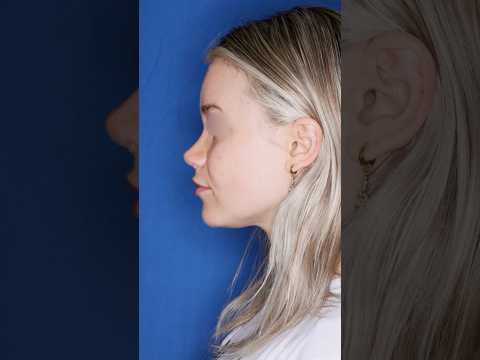 Video thumbnail: 25 & 2 months post-op ✨ Rhinoplasty by Dr. Ben Stong in Atlanta refined her curve, bridge & tip. · Kalos Facial Plastic Surgery