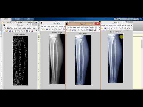 Bone Fracture Detection using Image Processing matlab Source code