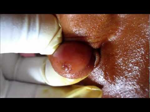 Sebaceous Cyst Ear Lobe- Draining