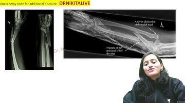 Mnemonic of the day - Galeazzi vs Monteggia fracture |Named fracture |Ortho mnemonics| Dr. Nikita