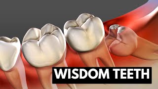 Wisdom teeth: Causes, Symptoms and Treatment