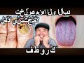 🦶 علاجات قوية للقضاء على فطريات القدم والأظافر 100%
