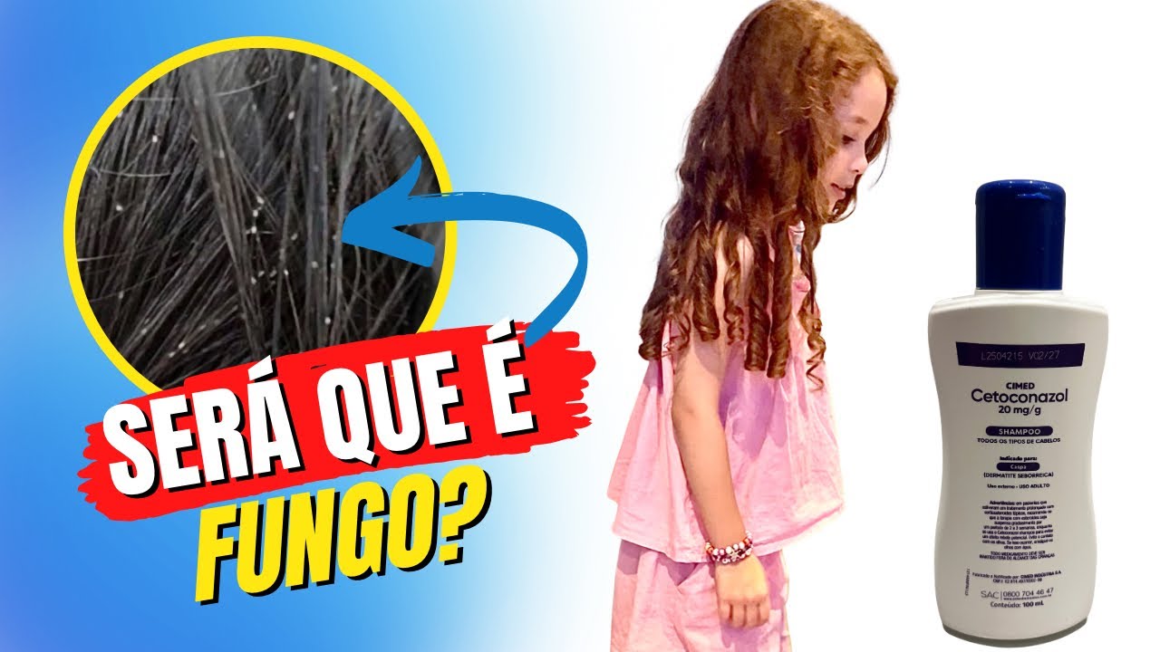Pontinhos brancos no cabelo da minha filha. Como identificar Piedra branca ou tricorrexe nodosa