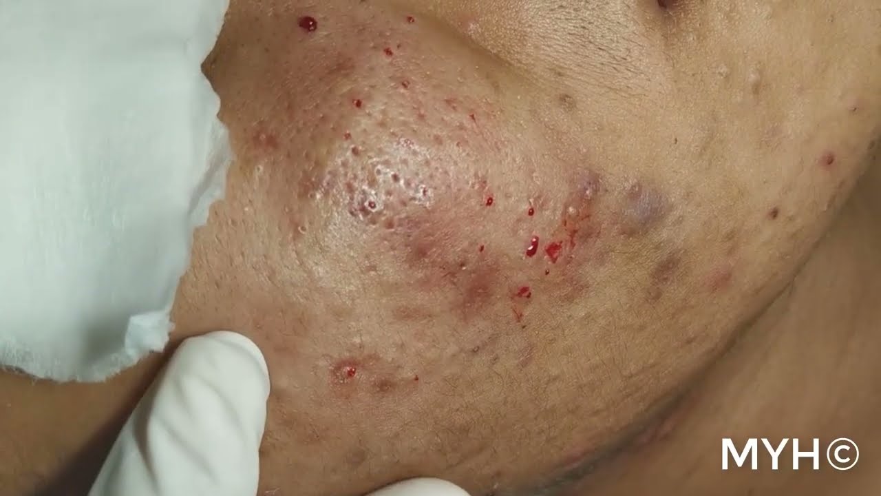 Blackheads Extraction l After he used soap look what happen on his face