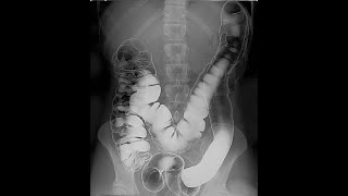 A Young Man Eats Taco Bell For An Entire Week. This Is What Happened To His Anus.
