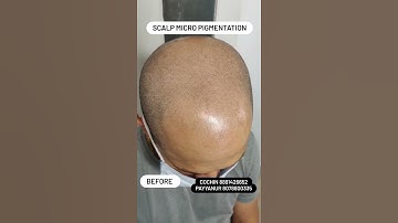 "baldness" no worries here is better option #scalpmicropigmentation #smp