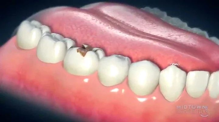 Can you put crowns on all your teeth? (2023)