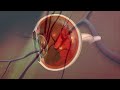 (Audio Description) Animation: Diabetic Retinopathy