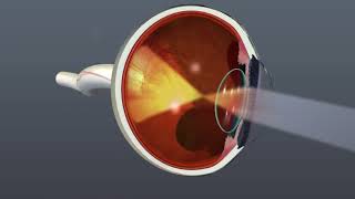 Audio Description Animation Diabetic Retinopathy