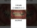 八重歯の矯正 #美容 #矯正歯科 #dentist