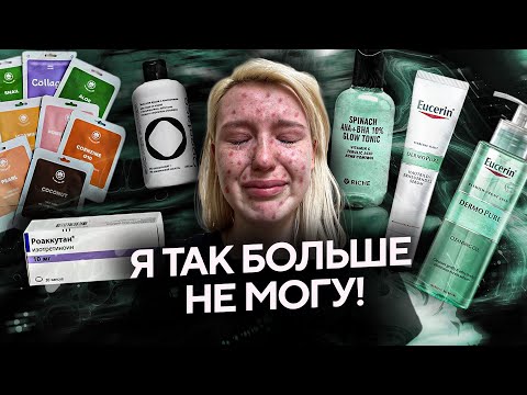 Моя история ЛЕЧЕНИЯ АКНЕ | УХОД | РОАККУТАН