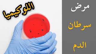 مرض سرطان الدم - اللوكيميا (Leukemia)