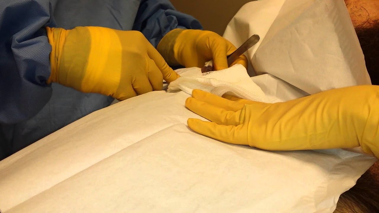 Perma cath removal YouTube