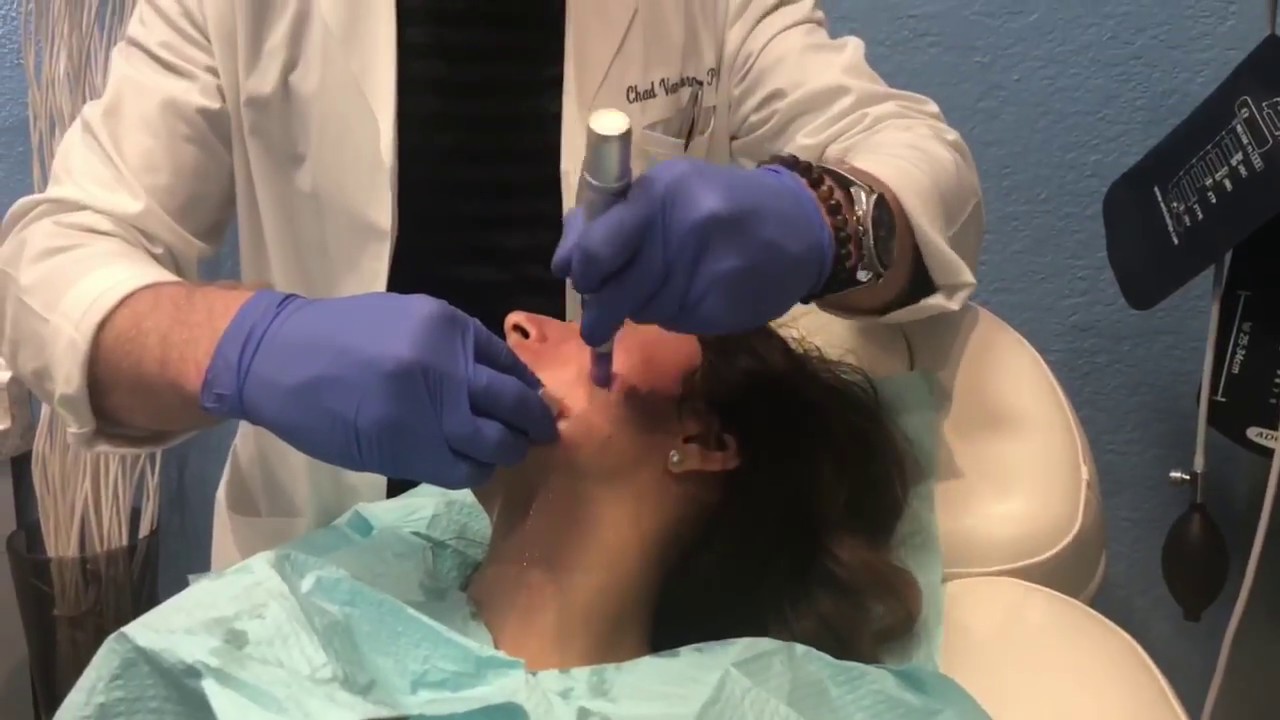 PRP Facial / Vampire Facelift at Liquivida Lounge