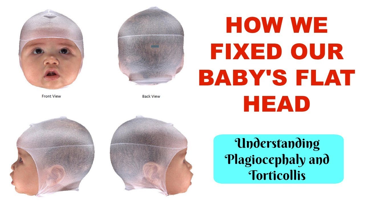 How We Fixed Our Baby S Head Without A Helmet Plagiocephaly Youtube