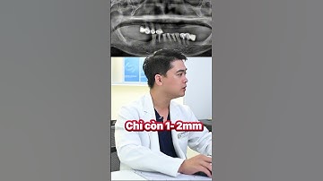 Implant trường hợp khó nhưng muốn có răng trong 2 tuần thì phải làm sao? #implant #nhakhoathuyanh