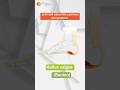Hallux Valgus #shortsfeed #youtubeshorts #shortsviral #shorts #shortvideo