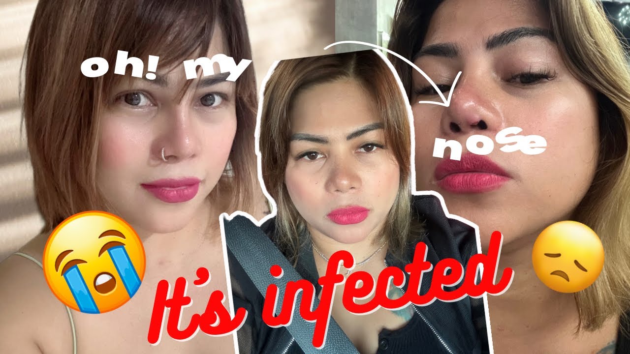 Why Is There A Hard Bump On My Nose 6 Months After Rhinoplasty Why Is There A Hard Bump On My Nose 6 Months After Rhinoplasty