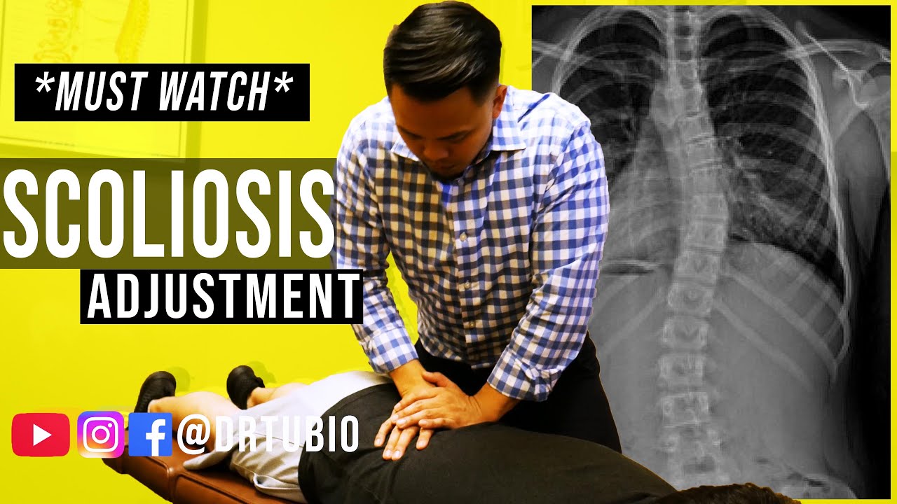 ⁣SEVERE SCOLIOSIS pain RELIEVED after Chiropractic Adjustments | Dr Alex Tubio