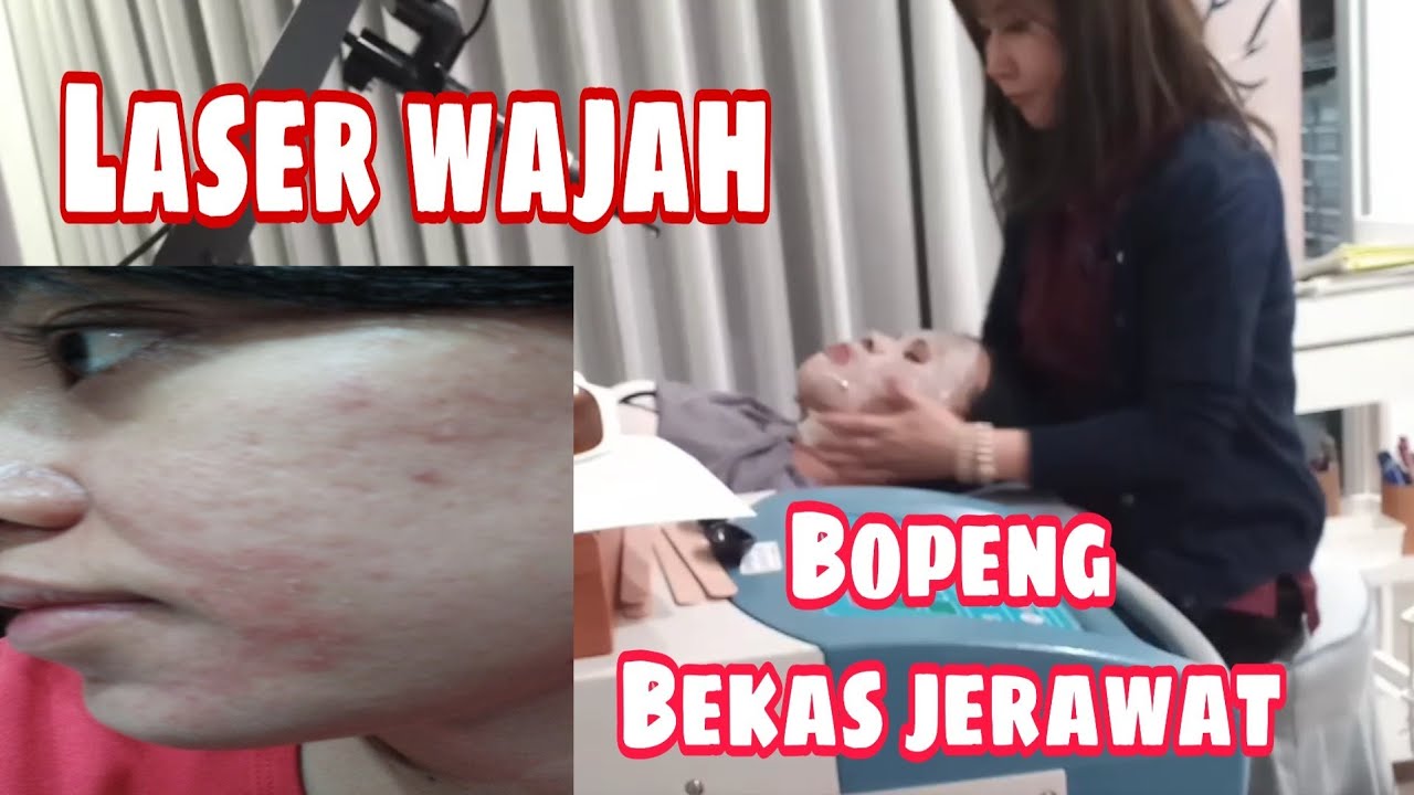 LASER WAJAH BOPENG BEKAS JERAWAT YouTube