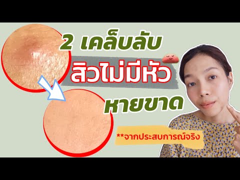 สิวไม่มีหัว ทำไงให้หาย จากประสบการณ์จริง!! ไม่ต้องบีบ แคะแกะเกาให้เป็นรอย | รักษาสิว | เฮลตี้นี่คะ