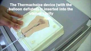 Demonstration on Endometrial ablation with Gynecare Thermachoice using a uterine model