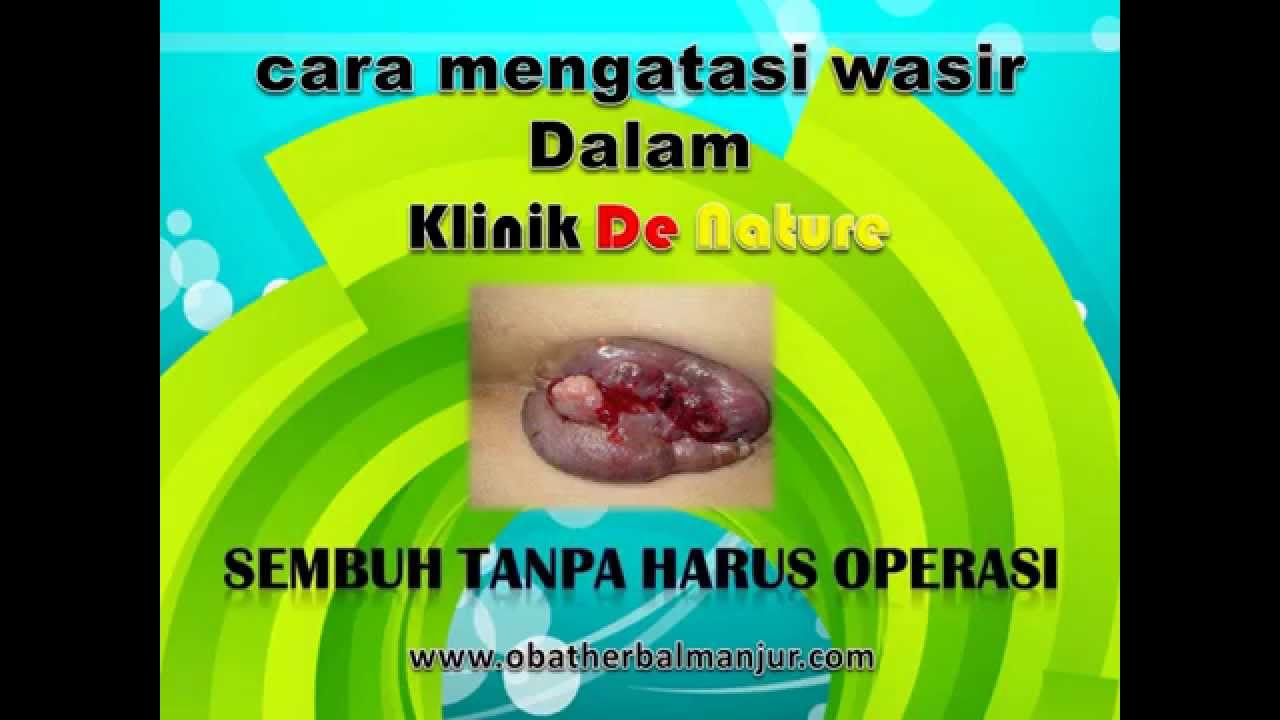 cara mengatasi wasir dalam