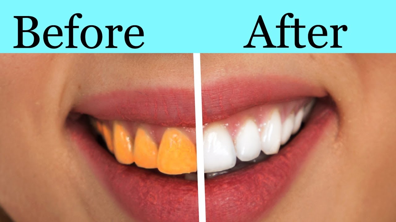 Teeth Whitening At Home In 5 Minutes || How To Whiten Your Yellow Teeth