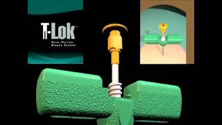 T-Lok Bone Marrow Biopsy System Procedure Video