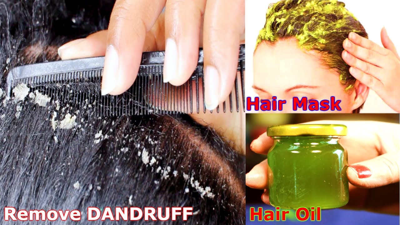 Magical Home Remedy to Remove DANDRUFF at homeDandruff treatmentHow to get  rid of dandruff  video Dailymotion