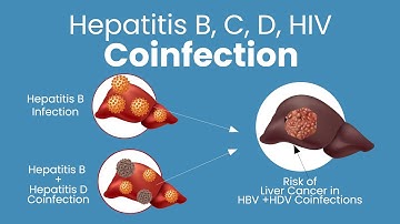 Hepatitis B and C Coinfection |  Hepatitis and HIV Coinfections | Hepatitis B and D Coinfection