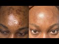 UNSPONSORED night time skincare routine for hyperpigmentation &amp; scarring