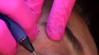 Insertion of the electrolysis probe into the hair follicle for effective permanent hair removal