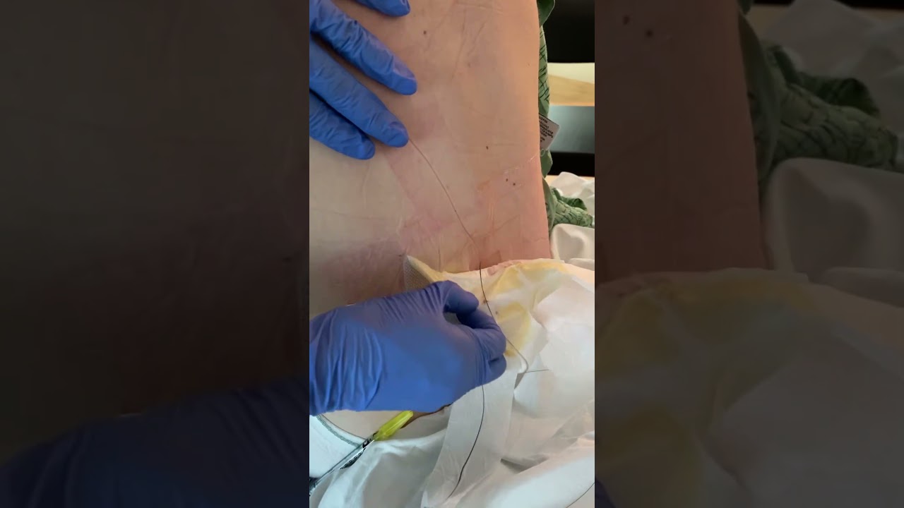 Wondering what it looks like to remove your epidural? #positivebirth #pregnancy #epidural