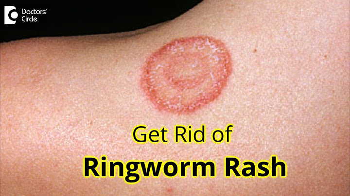 How to get rid of ringworm permanently