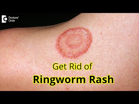 Ringworm Treatment | Antifungal Guide | Melbourne Sydney Australia