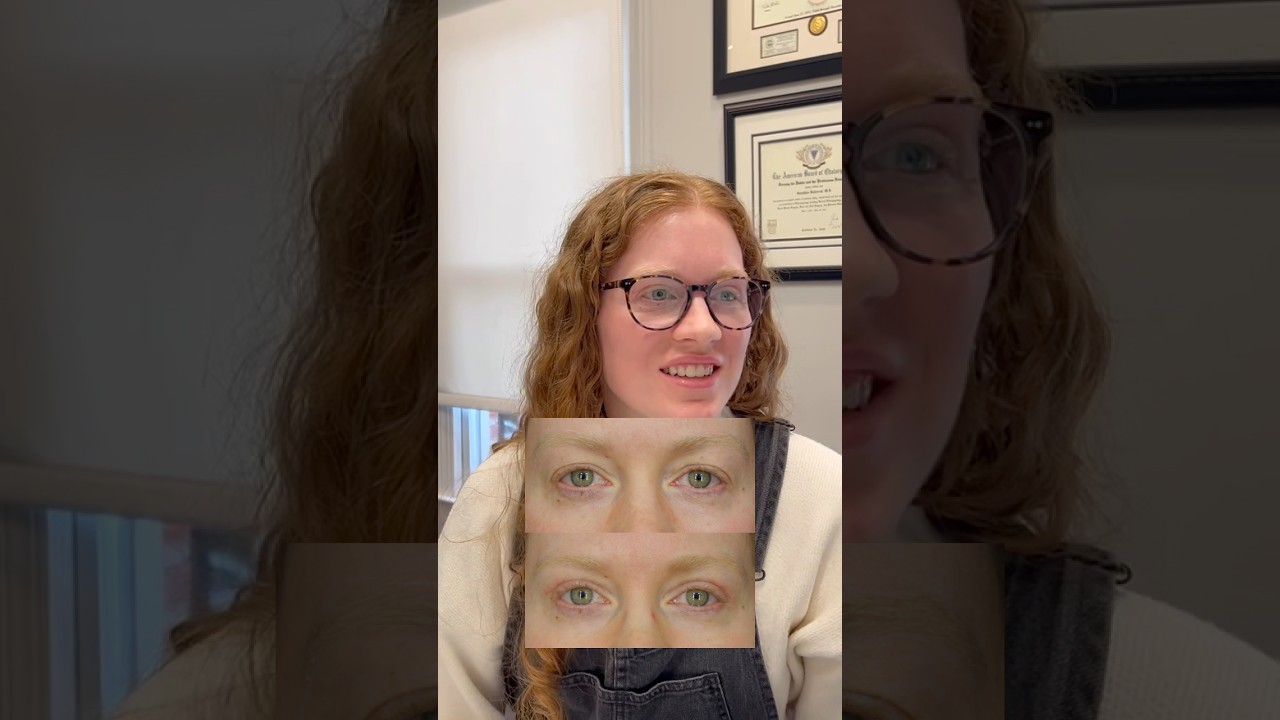 Upper Eyelid Lift Results