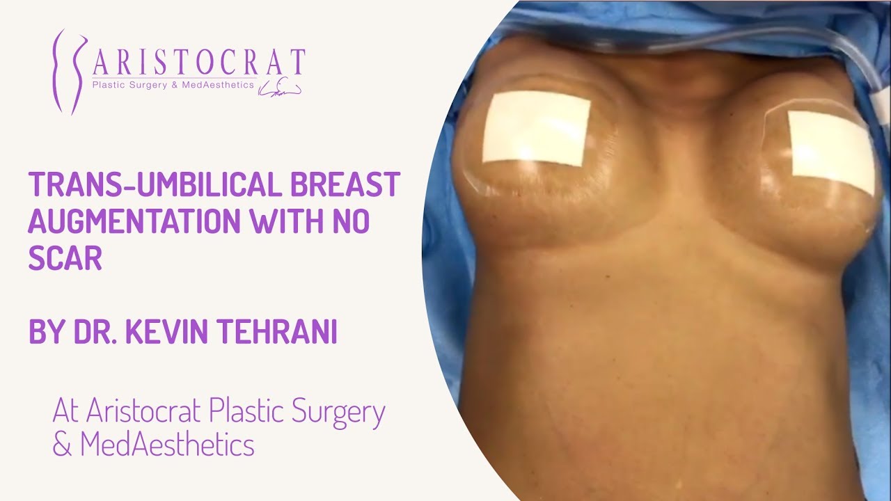 transumbilical breast augmentation surgeon Casual encounter sexual