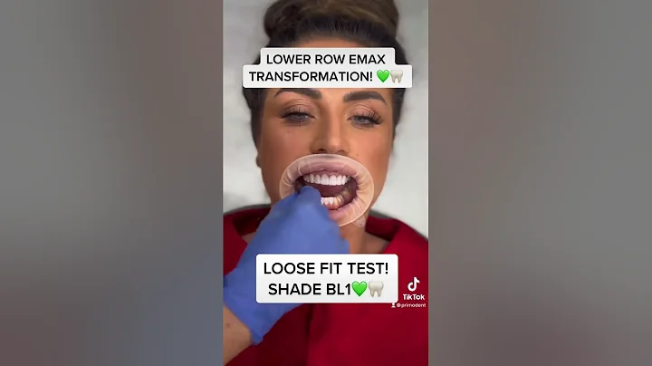 Primo Dental! Emax Veneers Loose Fit Try On Test! #shorts