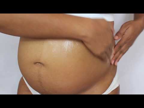 Video: How To Choose A Cream For Stretch Marks During Pregnancy