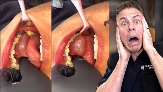 Dentist Reveals How Frog Mouth Could Happen To You!