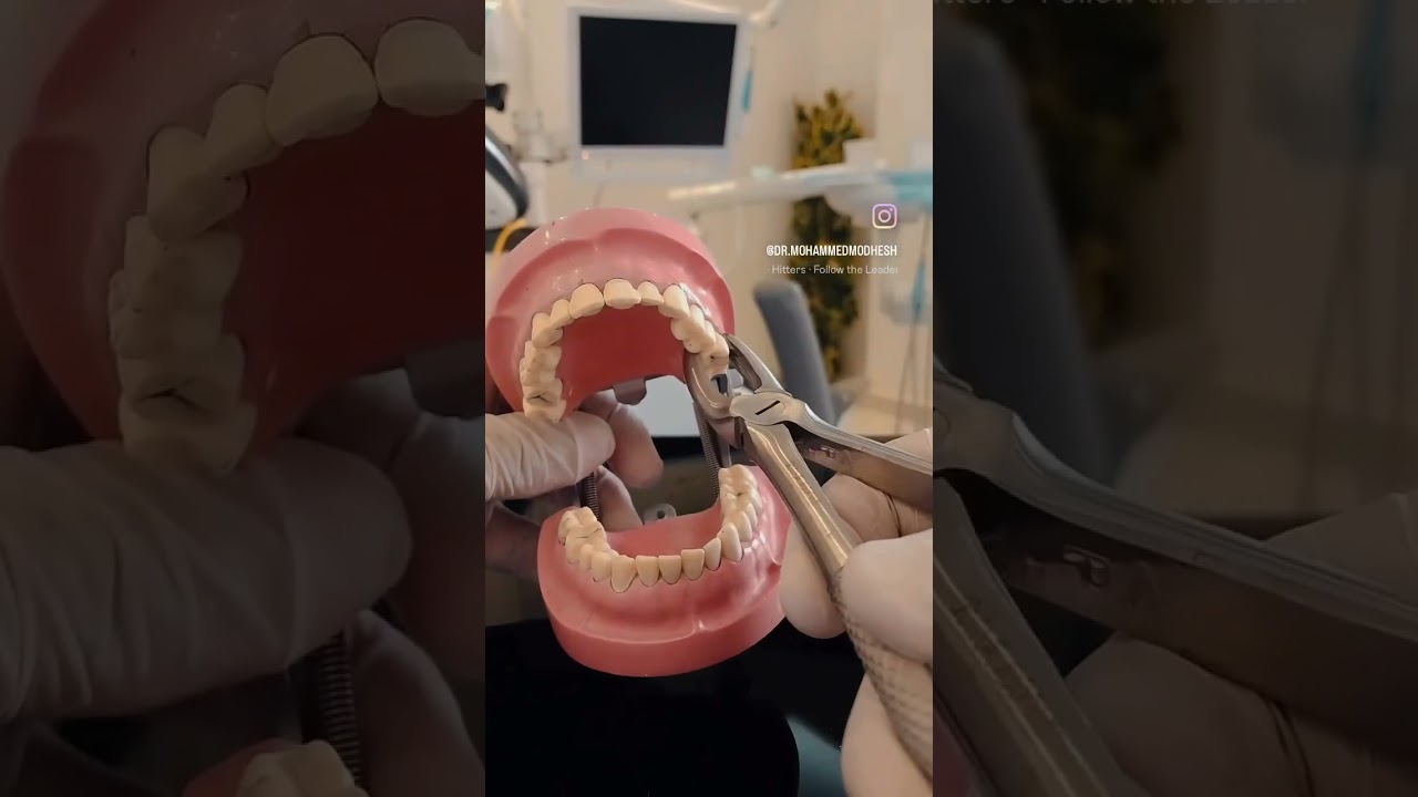 Maxillary molar extraction technique