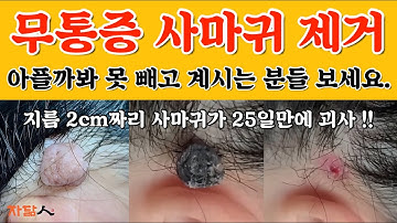 사마귀 제거하기 2탄!! 2cm 사마귀 냉동치료 없이 혹 떼기