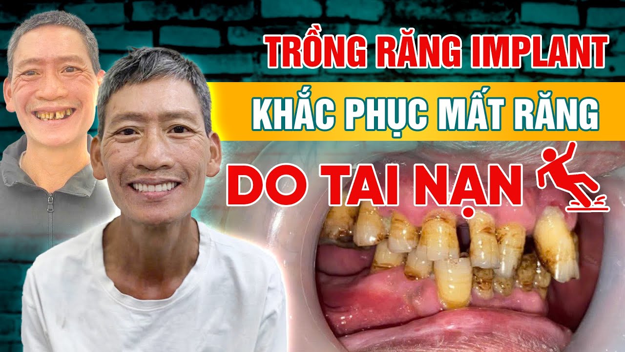 [Trồng Răng Implant] Khắc Phục Mất Răng Do Tai Nạn - YouTube