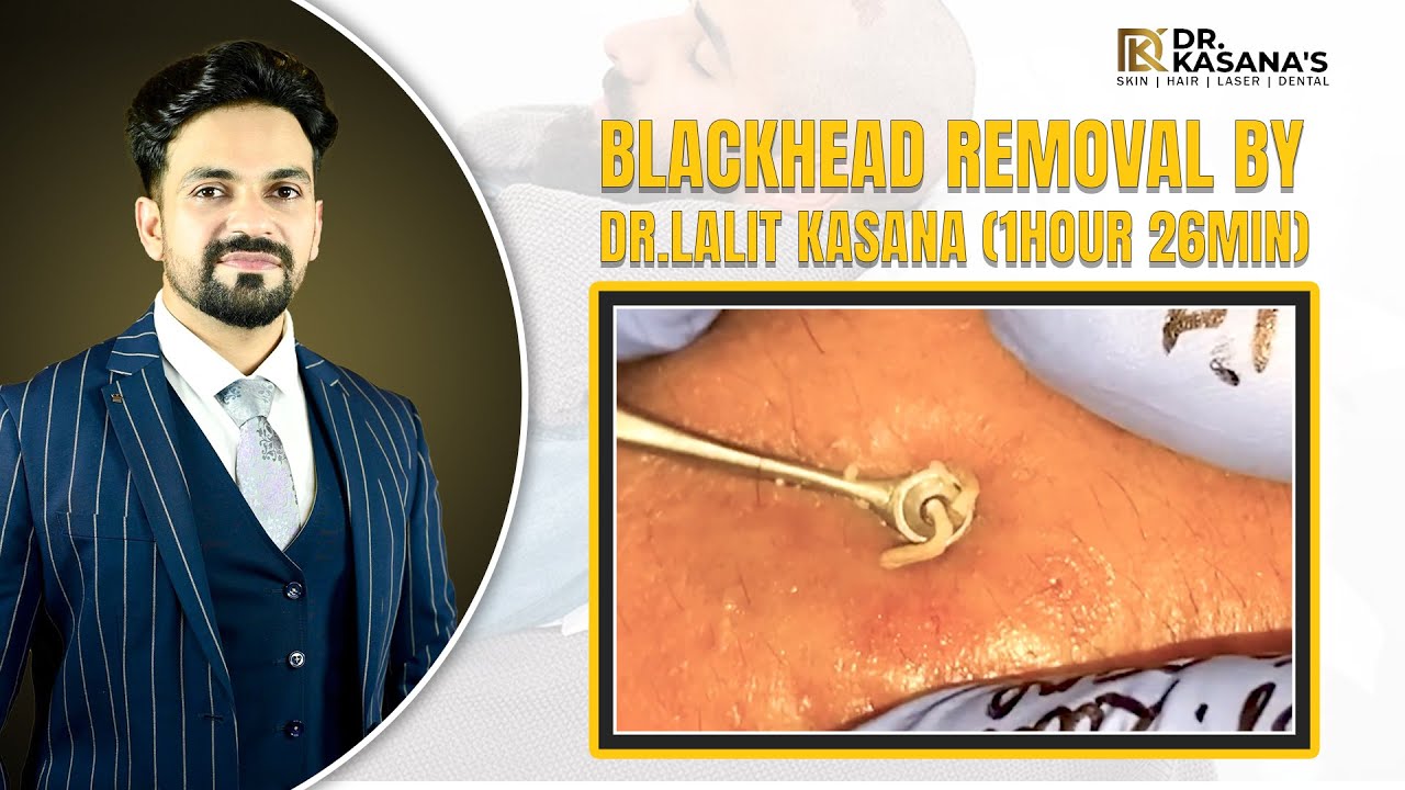 Deep Blackhead Removal FULL VIDEO II by Dr.Lalit Kasana II Relax Every