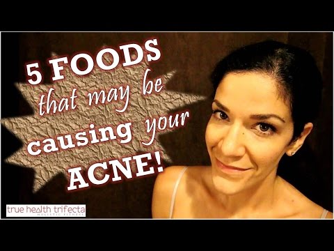 ACNE CAUSING FOODS:  Foods that may be giving you pimples! - Clear Skin / Acne / Vegan / Skin Tips