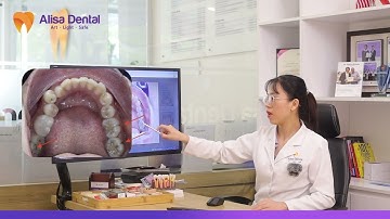 GIẢI THOÁT KHỚP CẮN NGƯỢC, KHẤP KHỂNH NẶNG VỚI PHƯƠNG PHÁP NIỀNG RĂNG