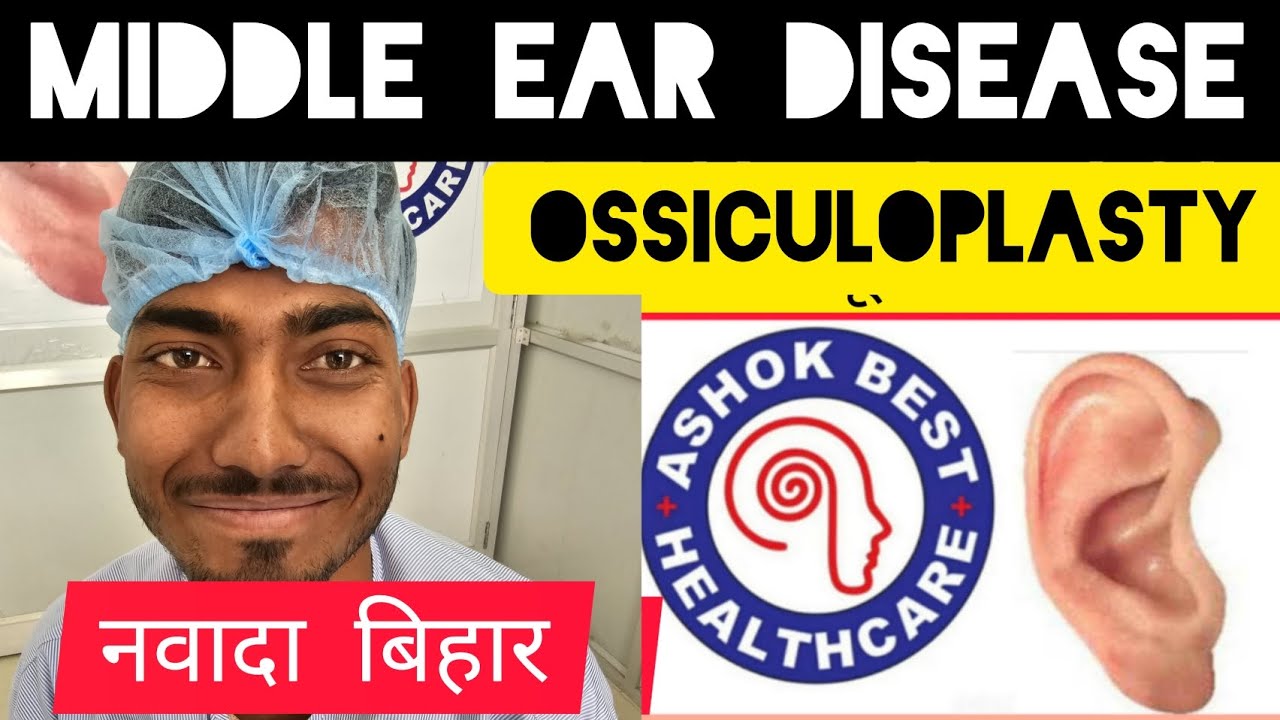 ENDOSCOPIC MIDDLE EAR SURGERY TRANSCANAL OSSICULOPLASTY मध्य कर्ण की अस्थियों का सफल ऑपरेशन